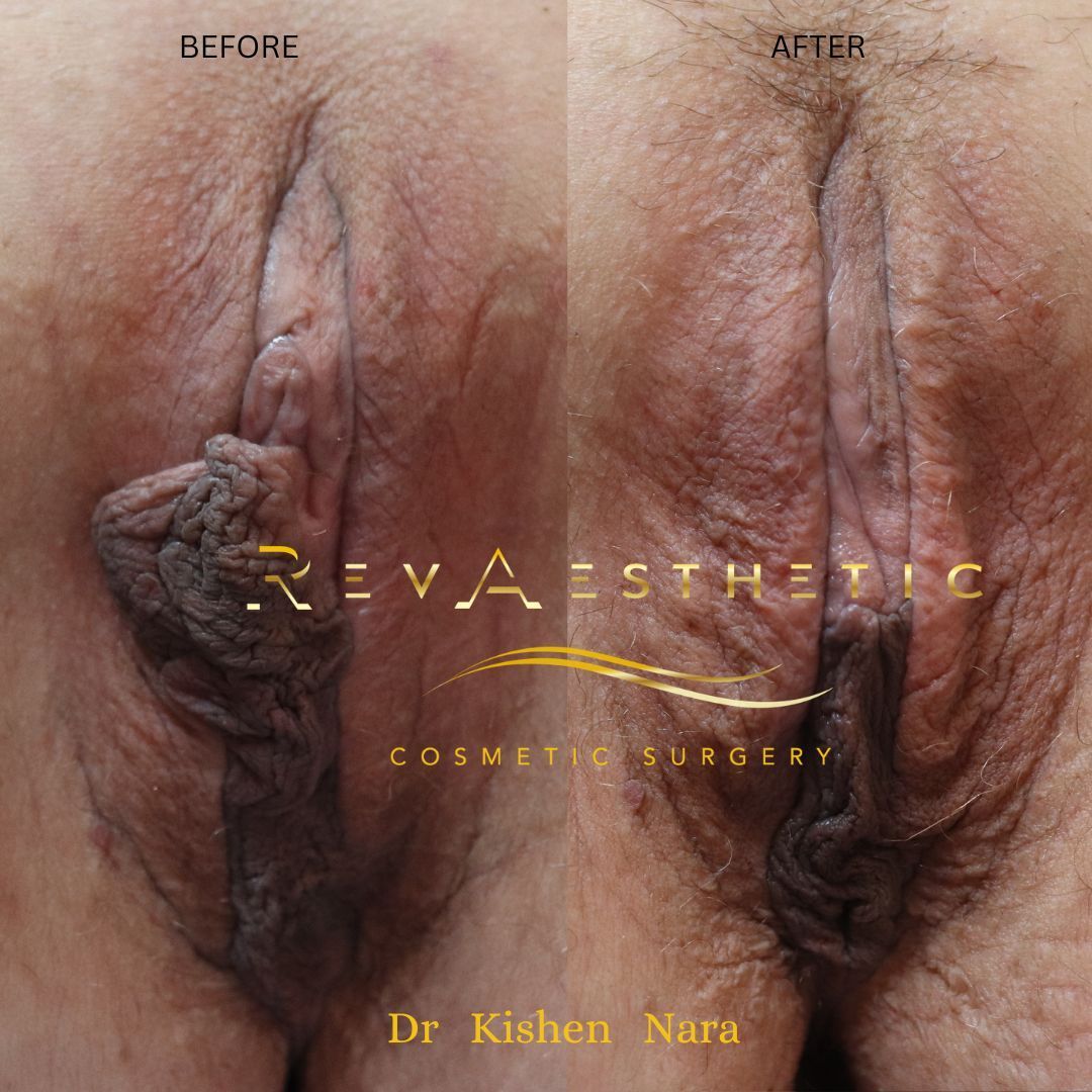Labiaplasty before and after — SAP labiaplasty, before and after, Case 4, Dr Kishen Nara